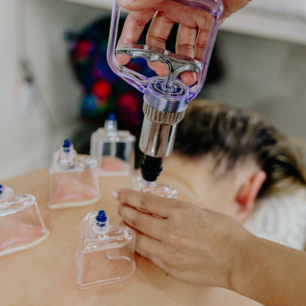 Cupping Therapy